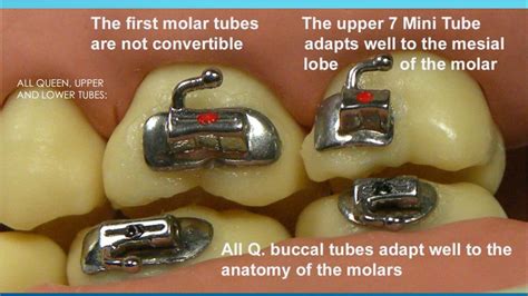 hoes does the metal bracket work on a 25 tube|Buccal Tube in Orthodontics: Uses, Positioning, and Comparison.